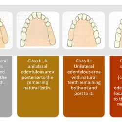 Types of clasps in rpd